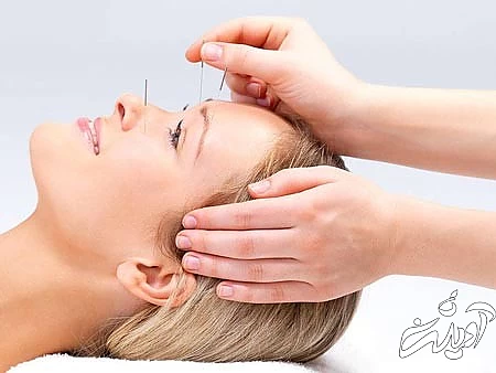 طب سوزنی بر جوانسازی پوست,رازهای مهم طب سوزنی برای زیبایی پوست صورت,جوانسازی با طب سوزنی